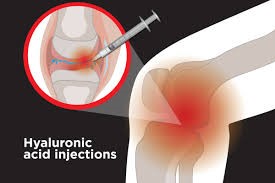 Hyaluronic Acid Injection